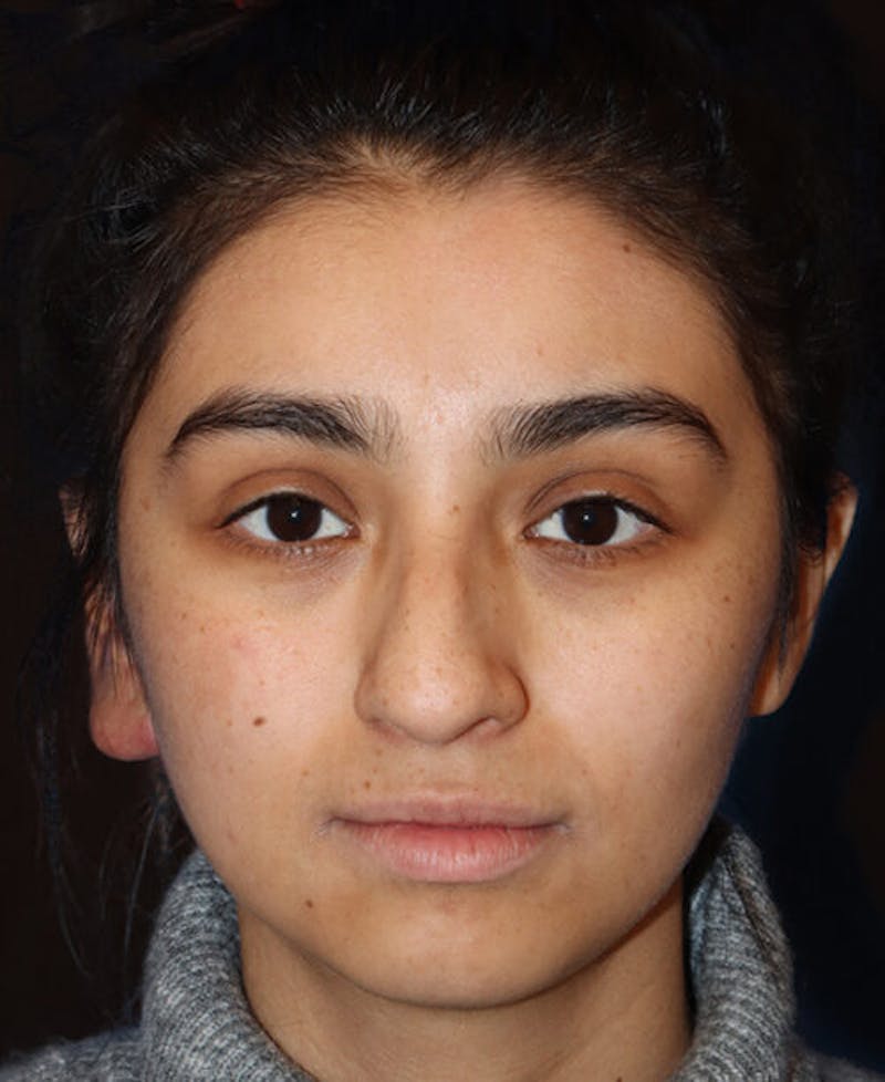 Rhinoplasty Before & After Gallery - Patient 127573 - Image 5