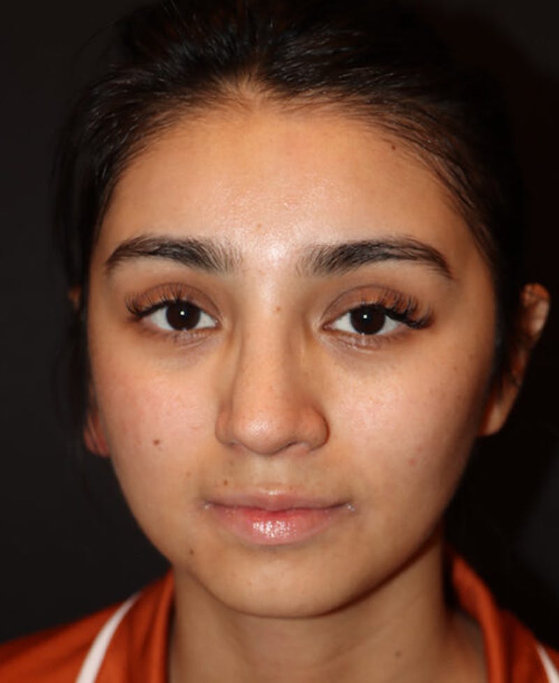 Rhinoplasty Before & After Gallery - Patient 127573 - Image 6