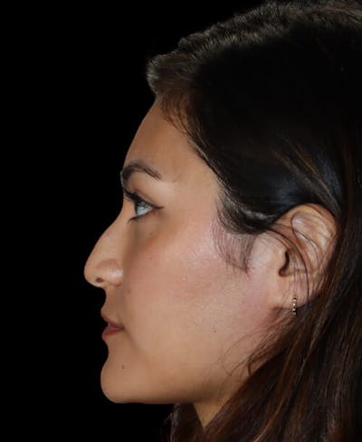 Rhinoplasty Before & After Gallery - Patient 341400 - Image 1