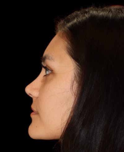 Rhinoplasty Before & After Gallery - Patient 341400 - Image 2