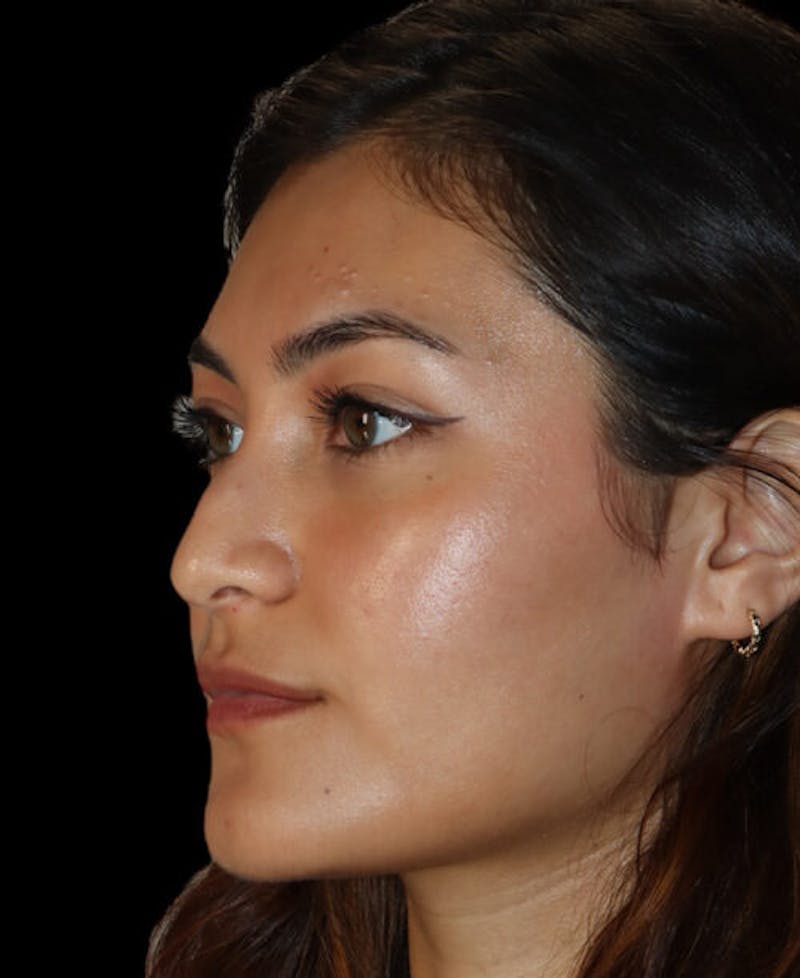 Rhinoplasty Before & After Gallery - Patient 341400 - Image 3