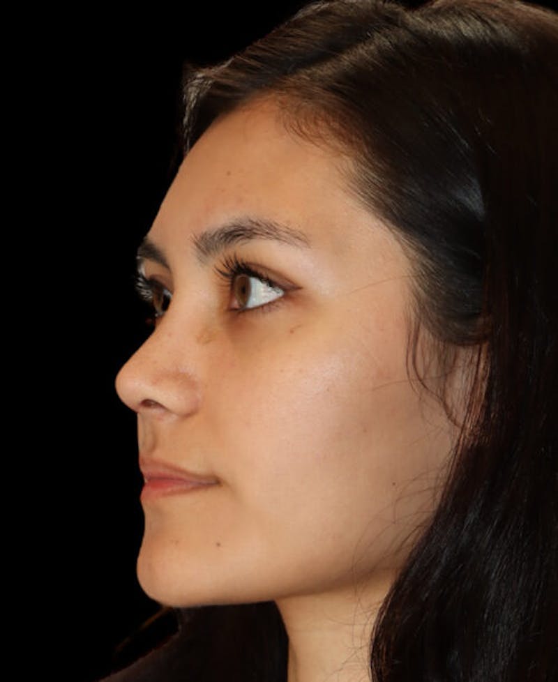 Rhinoplasty Before & After Gallery - Patient 341400 - Image 4