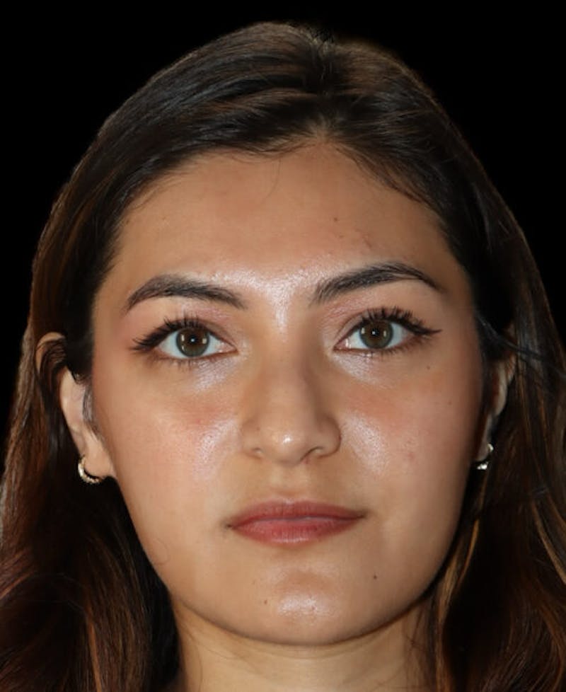 Rhinoplasty Before & After Gallery - Patient 341400 - Image 5