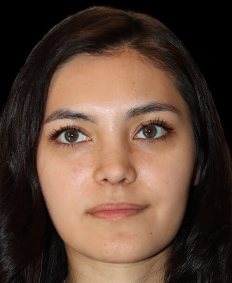 Rhinoplasty Before & After Gallery - Patient 341400 - Image 6