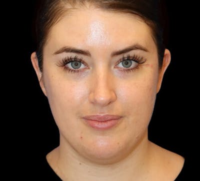 Submental (Chin) Liposuction Before & After Gallery - Patient 145743 - Image 1