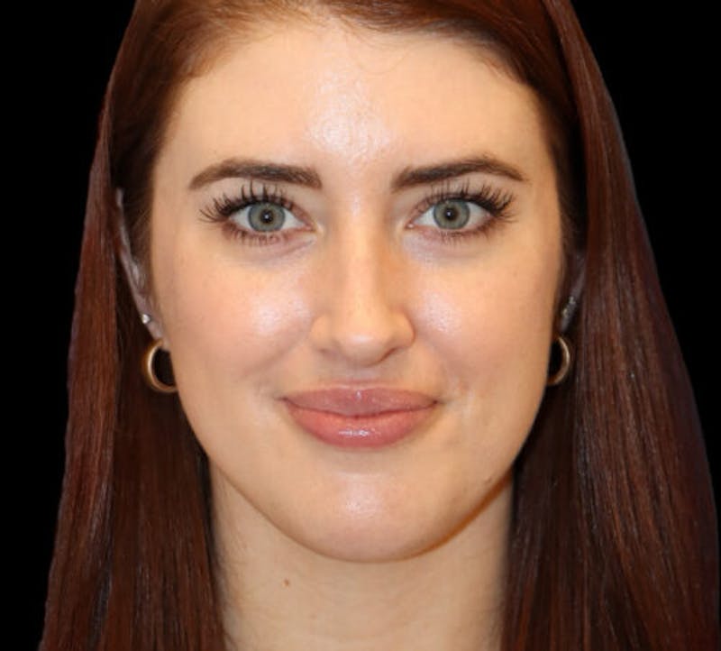 Submental (Chin) Liposuction Before & After Gallery - Patient 145743 - Image 2