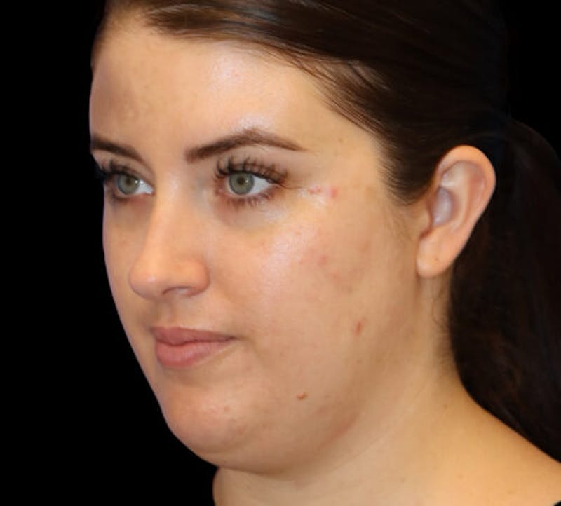 Submental (Chin) Liposuction Before & After Gallery - Patient 145743 - Image 3