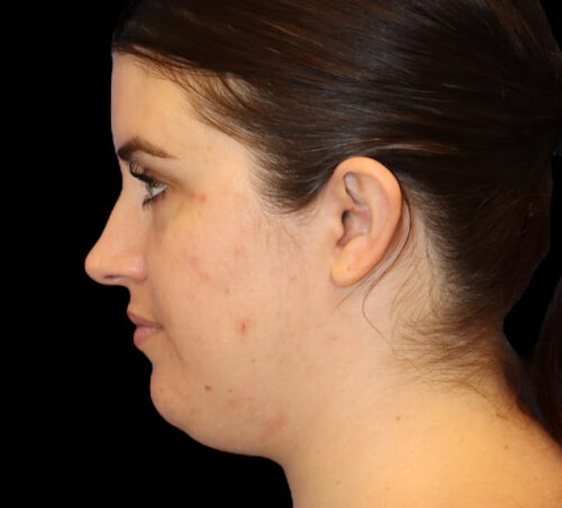 Submental (Chin) Liposuction Before & After Gallery - Patient 145743 - Image 5