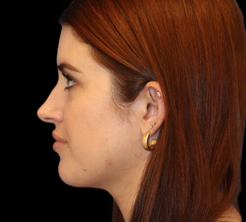 Submental (Chin) Liposuction Before & After Gallery - Patient 145743 - Image 6