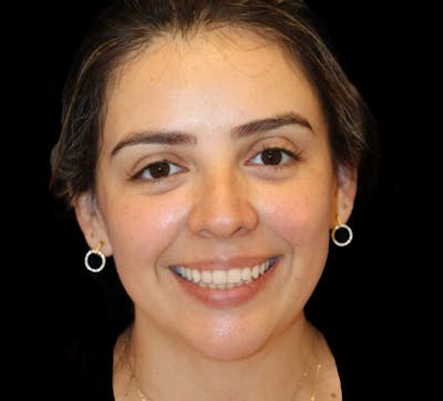 Submental (Chin) Liposuction Before & After Gallery - Patient 141182 - Image 1