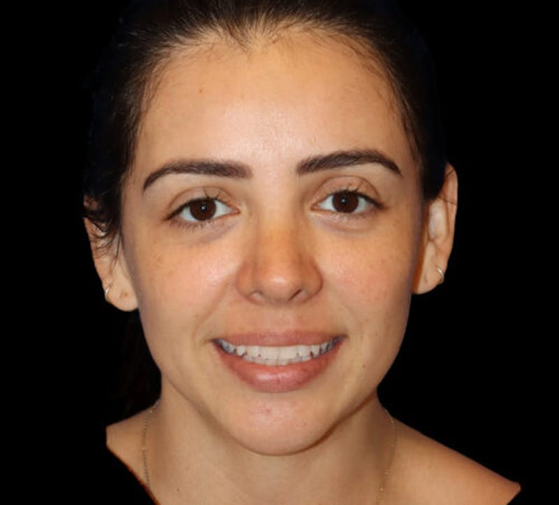 Submental (Chin) Liposuction Before & After Gallery - Patient 141182 - Image 2