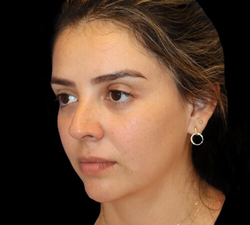 Submental (Chin) Liposuction Before & After Gallery - Patient 141182 - Image 3