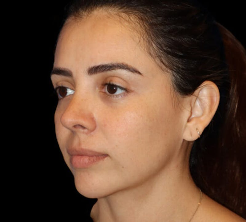 Submental (Chin) Liposuction Before & After Gallery - Patient 141182 - Image 4