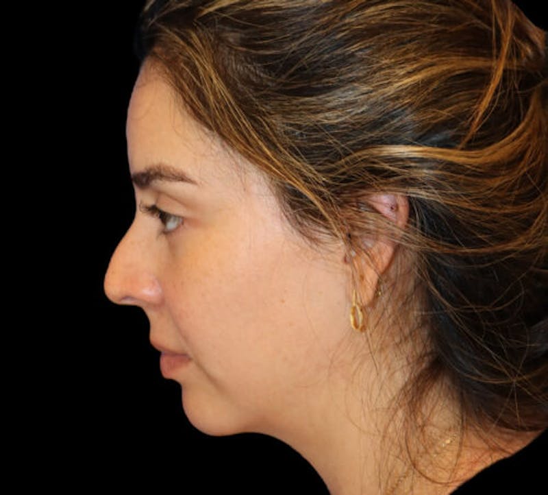 Submental (Chin) Liposuction Before & After Gallery - Patient 141182 - Image 5