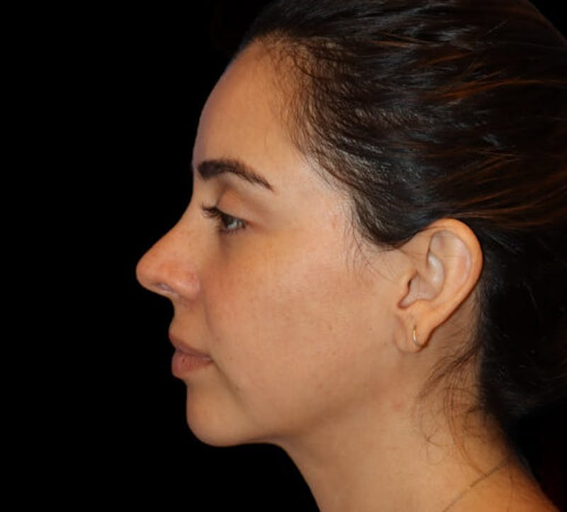 Submental (Chin) Liposuction Before & After Gallery - Patient 141182 - Image 6