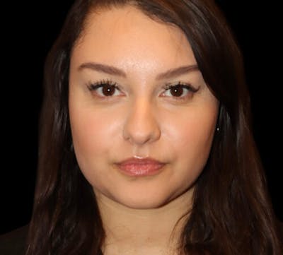 Non-Surgical Rhinoplasty Before & After Gallery - Patient 227155 - Image 1