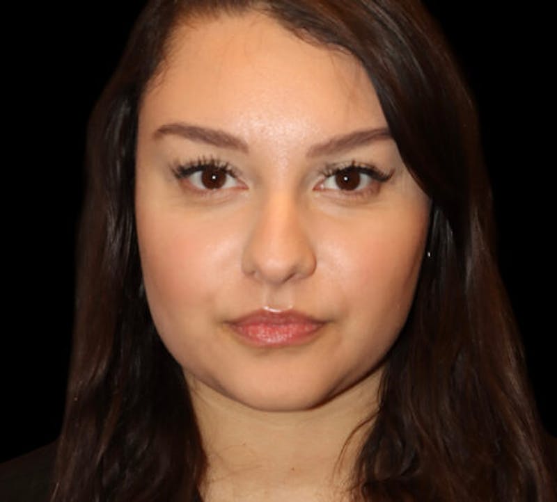 Non-Surgical Rhinoplasty Before & After Gallery - Patient 227155 - Image 1