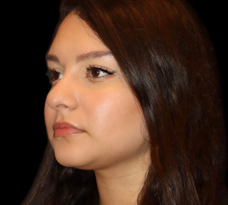 Non-Surgical Rhinoplasty Before & After Gallery - Patient 227155 - Image 3