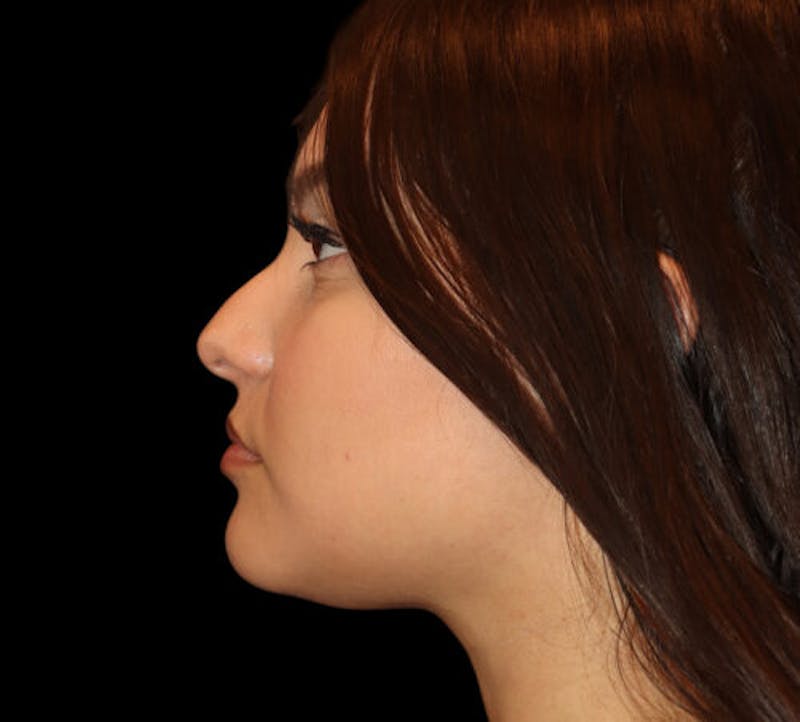 Non-Surgical Rhinoplasty Before & After Gallery - Patient 227155 - Image 5