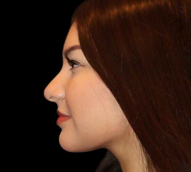 Non-Surgical Rhinoplasty Before & After Gallery - Patient 227155 - Image 6