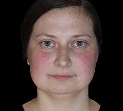 Submental (Chin) Liposuction Before & After Gallery - Patient 168246 - Image 1