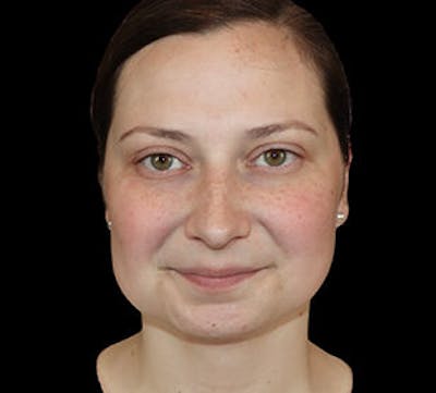 Submental (Chin) Liposuction Before & After Gallery - Patient 168246 - Image 2