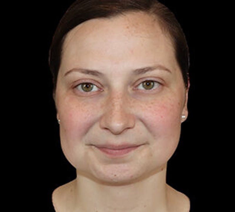 Submental (Chin) Liposuction Before & After Gallery - Patient 168246 - Image 2