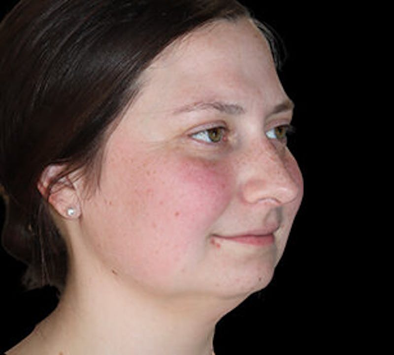 Submental (Chin) Liposuction Before & After Gallery - Patient 168246 - Image 3