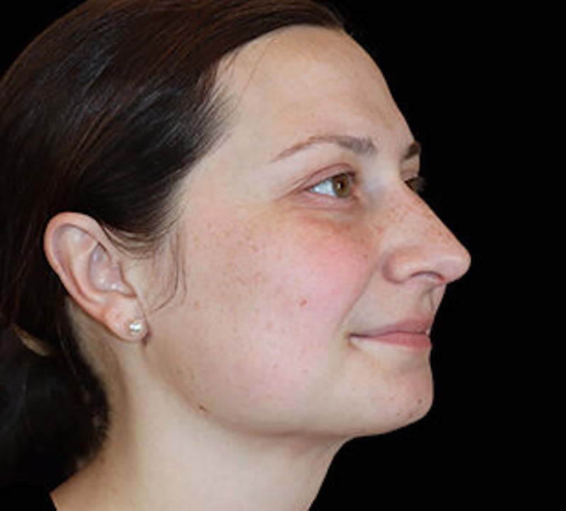Submental (Chin) Liposuction Before & After Gallery - Patient 168246 - Image 4