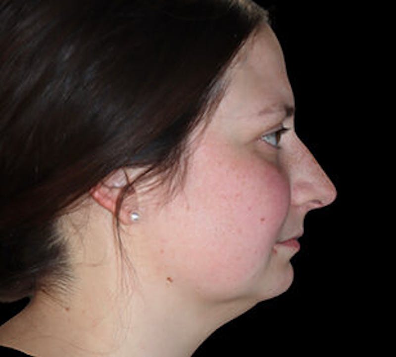 Submental (Chin) Liposuction Before & After Gallery - Patient 168246 - Image 5