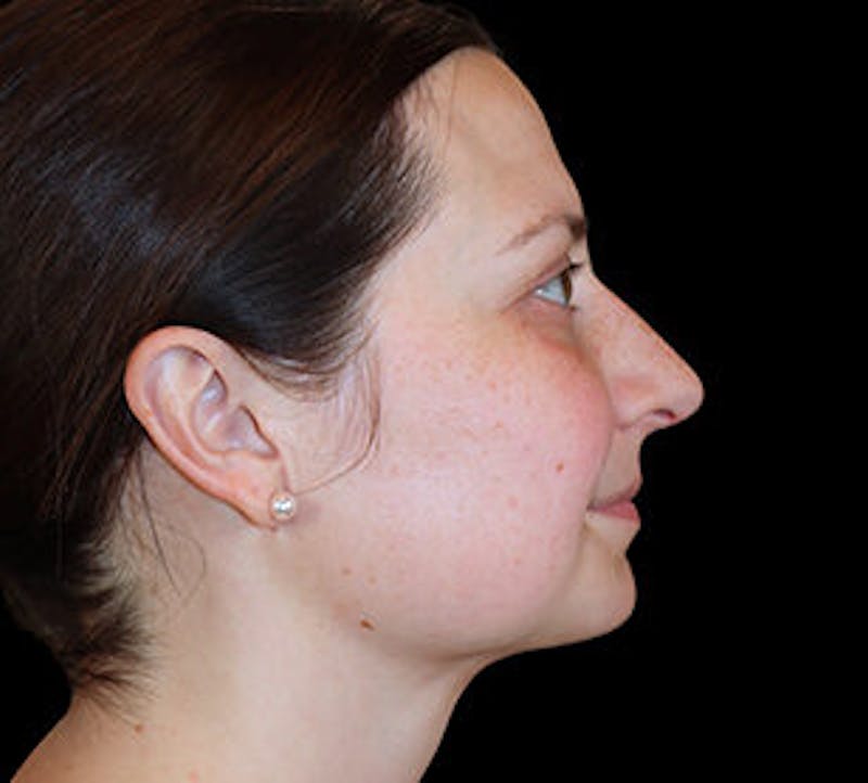 Submental (Chin) Liposuction Before & After Gallery - Patient 168246 - Image 6