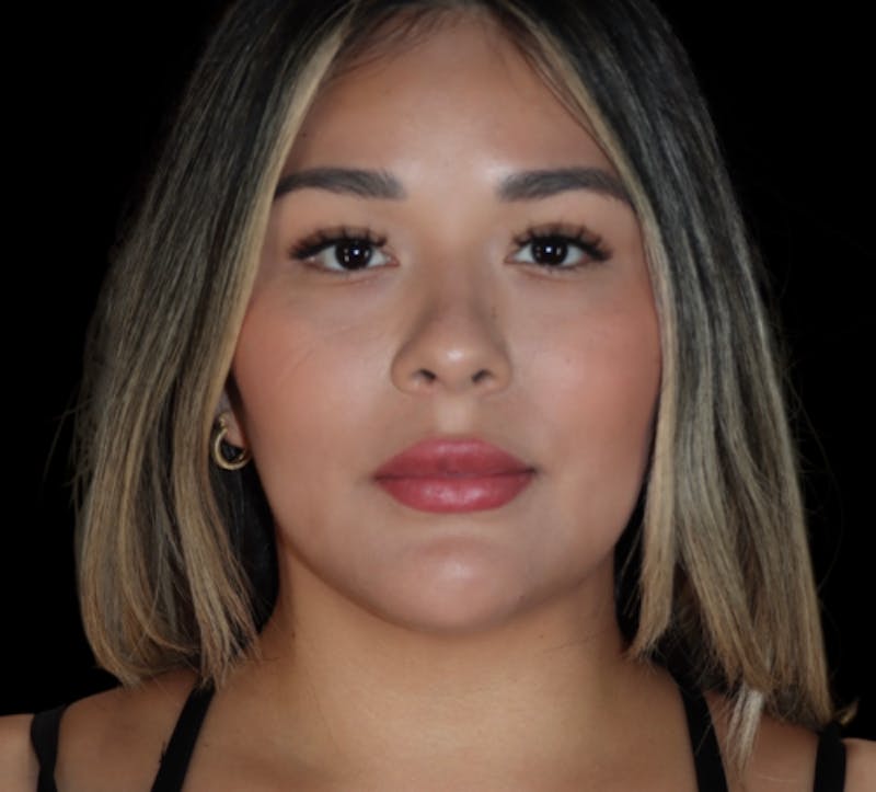 Submental (Chin) Liposuction Before & After Gallery - Patient 340207 - Image 1