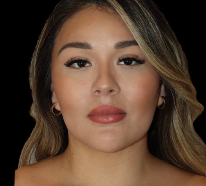 Submental (Chin) Liposuction Before & After Gallery - Patient 340207 - Image 2