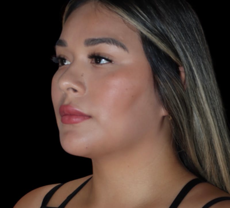 Submental (Chin) Liposuction Before & After Gallery - Patient 340207 - Image 3