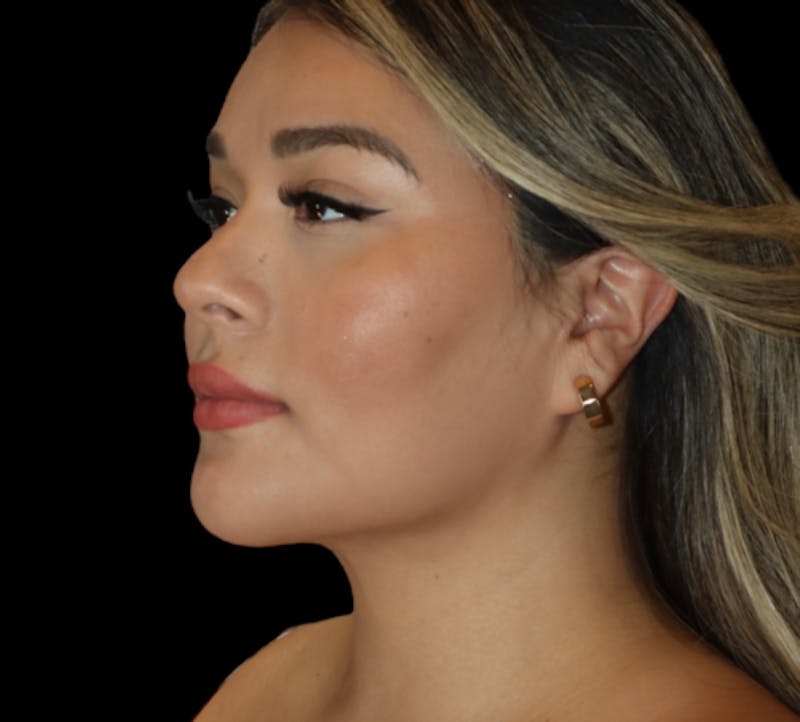 Submental (Chin) Liposuction Before & After Gallery - Patient 340207 - Image 4