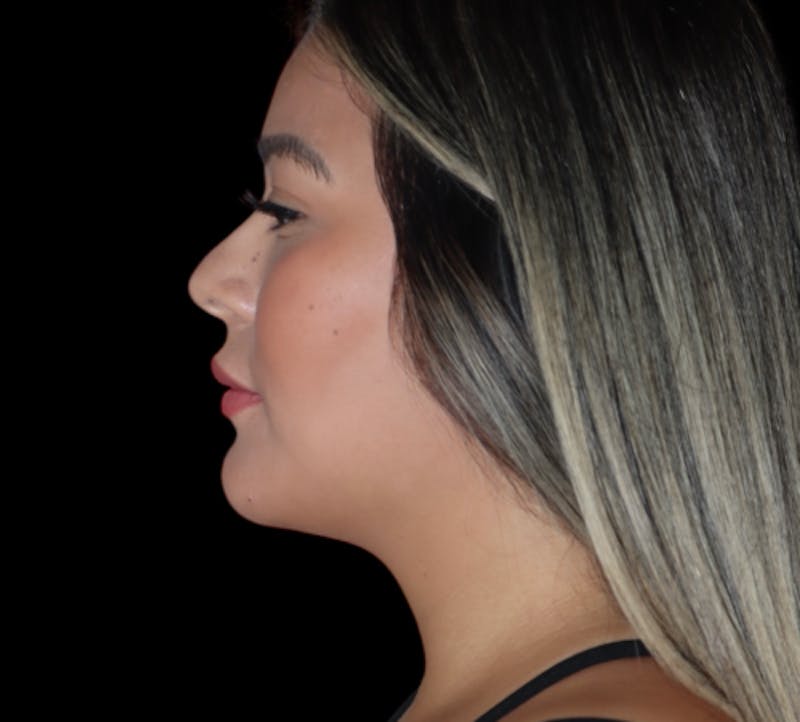 Submental (Chin) Liposuction Before & After Gallery - Patient 340207 - Image 5