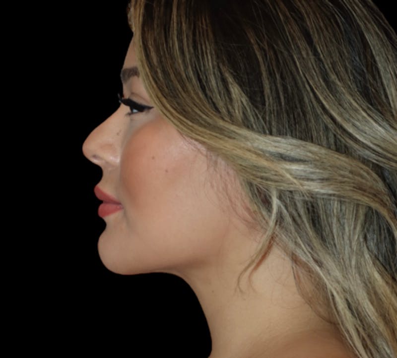 Submental (Chin) Liposuction Before & After Gallery - Patient 340207 - Image 6