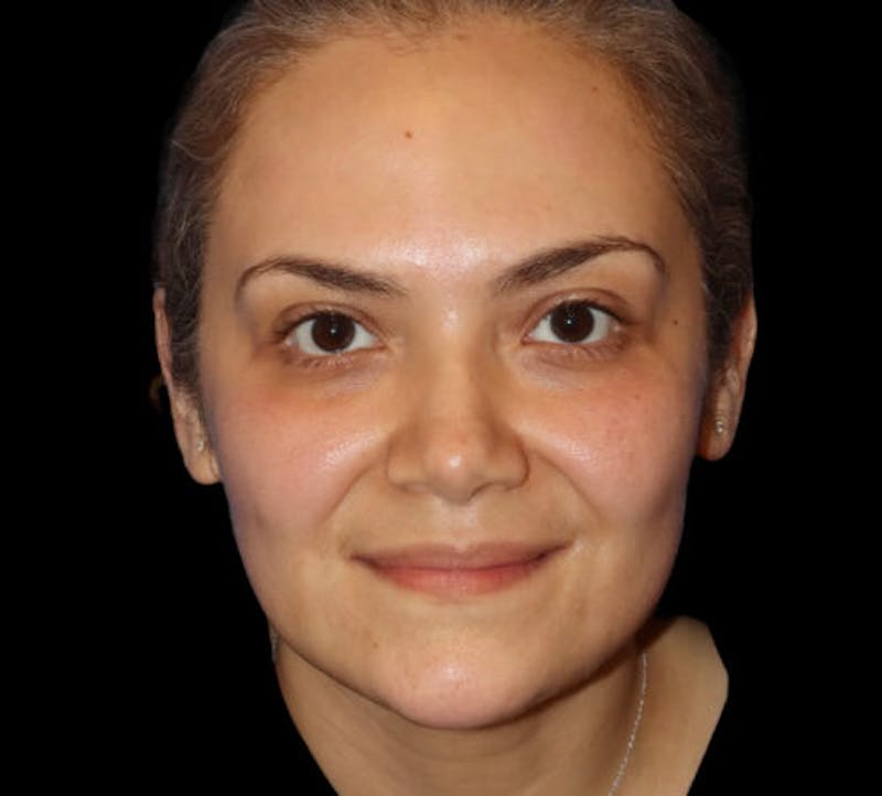 Submental (Chin) Liposuction Before & After Gallery - Patient 282938 - Image 1