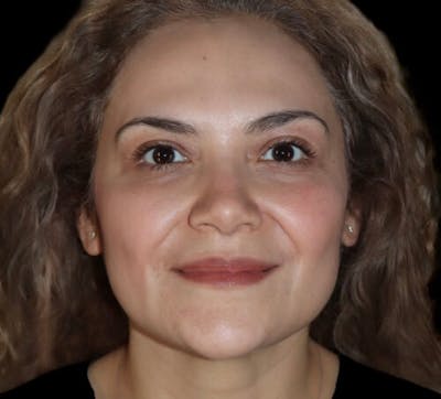 Submental (Chin) Liposuction Before & After Gallery - Patient 282938 - Image 2