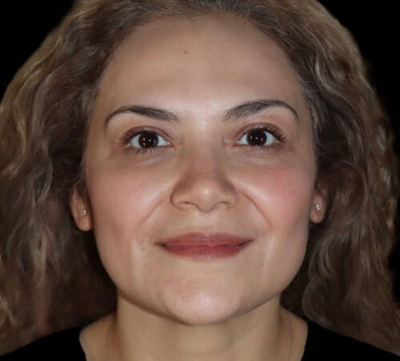 Submental (Chin) Liposuction Before & After Gallery - Patient 282938 - Image 2