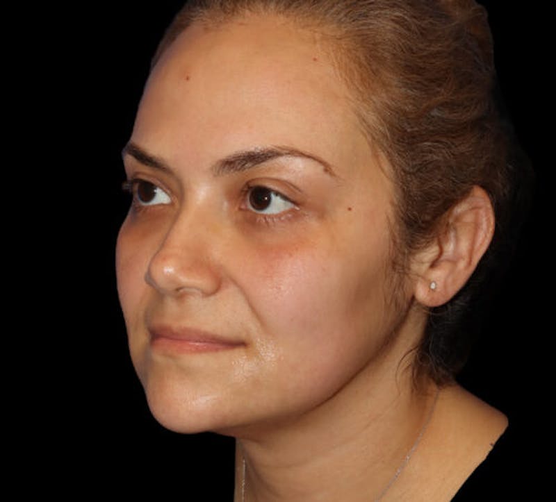 Submental (Chin) Liposuction Before & After Gallery - Patient 282938 - Image 3