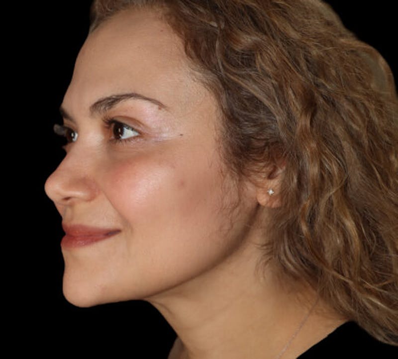 Submental (Chin) Liposuction Before & After Gallery - Patient 282938 - Image 4