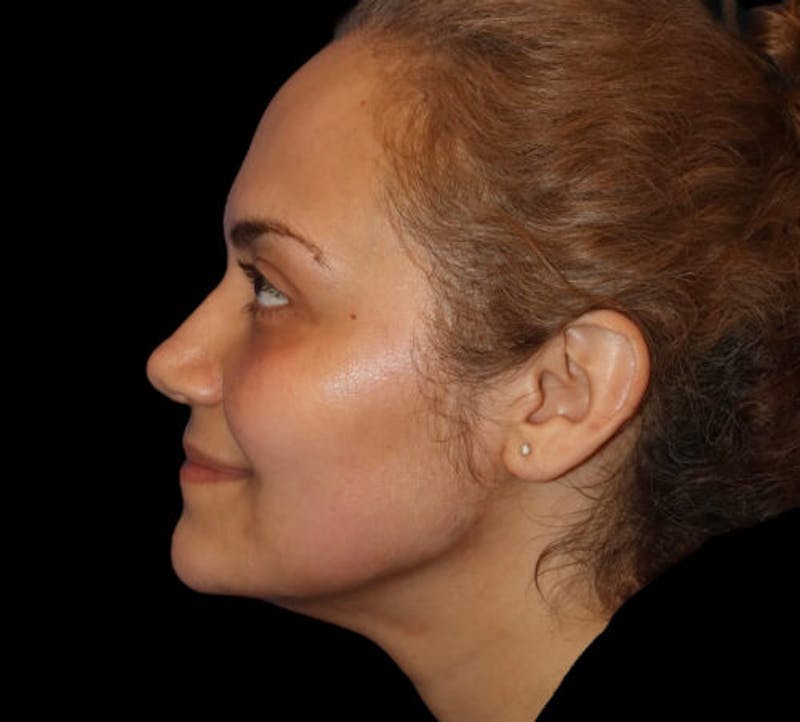 Submental (Chin) Liposuction Before & After Gallery - Patient 282938 - Image 5