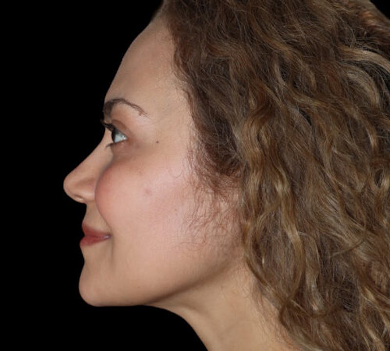 Submental (Chin) Liposuction Before & After Gallery - Patient 282938 - Image 6