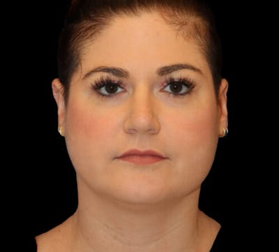 Submental (Chin) Liposuction Before & After Gallery - Patient 116375 - Image 1