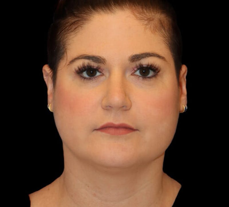 Submental (Chin) Liposuction Before & After Gallery - Patient 116375 - Image 1
