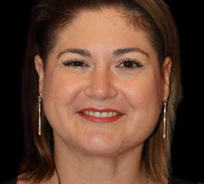 Submental (Chin) Liposuction Before & After Gallery - Patient 116375 - Image 2