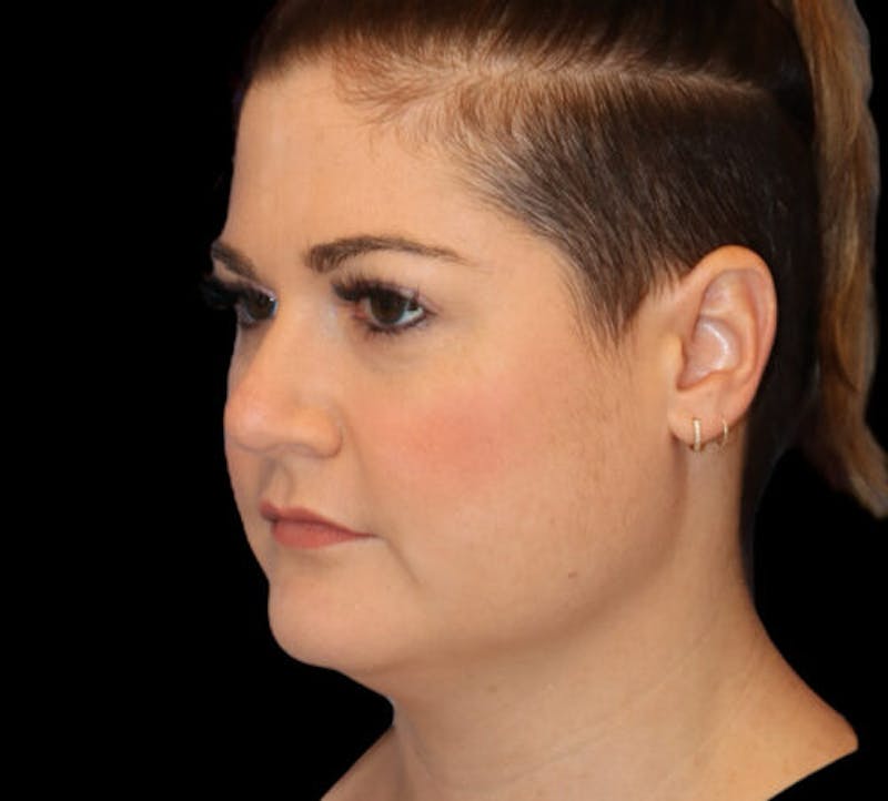 Submental (Chin) Liposuction Before & After Gallery - Patient 116375 - Image 3