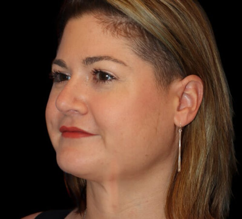 Submental (Chin) Liposuction Before & After Gallery - Patient 116375 - Image 4