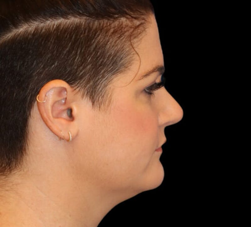 Submental (Chin) Liposuction Before & After Gallery - Patient 116375 - Image 5